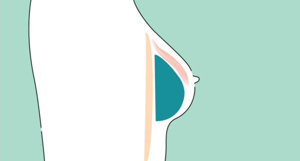 Lage des Implantats hinter dem Muskel Lage des Implantats hinter dem Muskel
