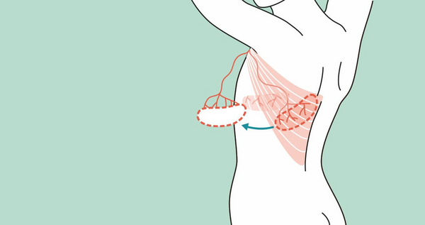 Hebung Latissimus dorsi Lappen Hebung Latissimus dorsi Lappen